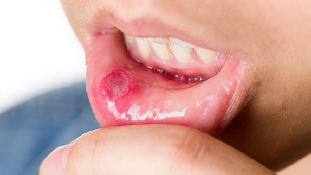 cause of cold sore on tongue